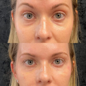Icon Aesthetics Highlights Under-Eye Filler in Pompano